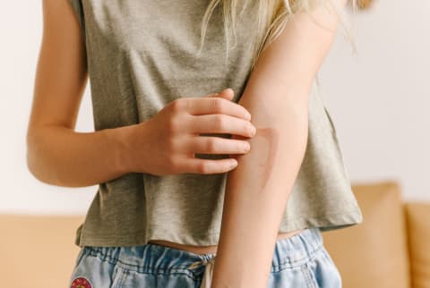  woman touching dark red burn on tender skin of arm