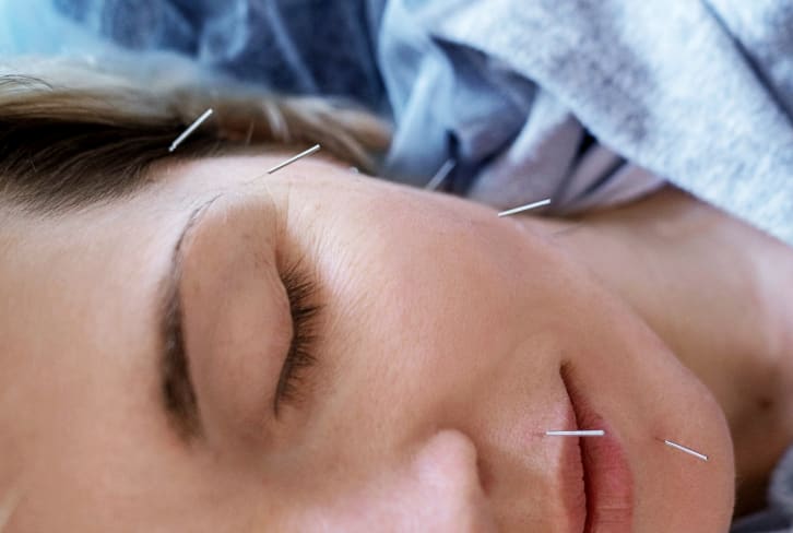 Having Problems With Menopause? You May Want To Try Acupuncture, Study Finds