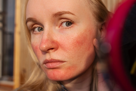 woman with rosacea looking in mirror