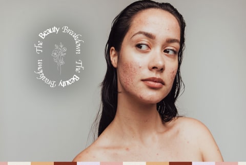 beauty breakdown adult with acne