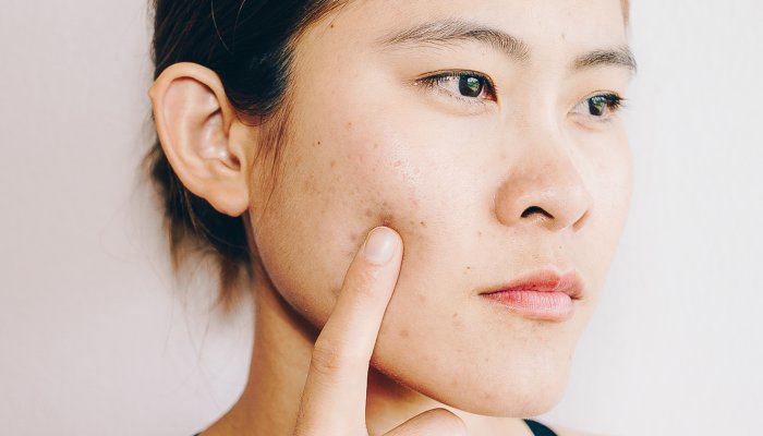 The Best (& We Mean Best) Guide To Getting Rid Of Inflammatory Acne 1