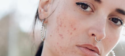 Is It Acne Or Rosacea? How To Spot The Difference, According To Derms