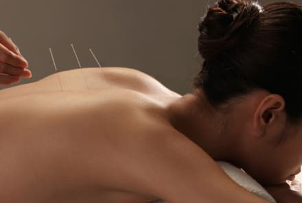 5 Reasons You Should Try Acupuncture Right Now