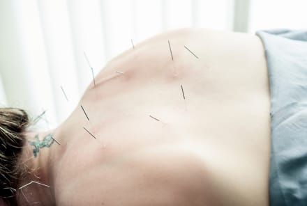 Why I Prescribe Acupuncture: A Cardiologist Explains