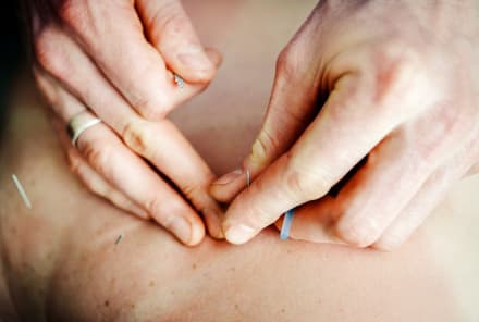 Calling All Acupuncture Skeptics: Here Are Some Great Reasons To Give It A Try