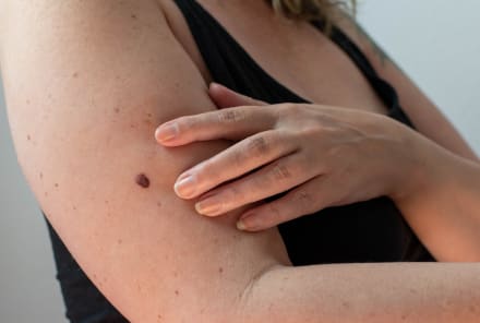 Have Bumps On Your Arms? This Surprising Habit Makes KP Worse