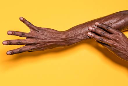 Dry, Cracked Hands? It Could Be Eczema — Here's What Experts Say To Do