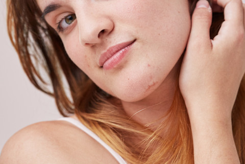 woman with slight acne on her chin woman with slight acne on her chin