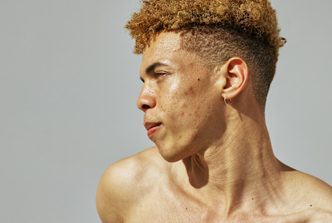 Side profile of man with skin texture and acne scars on his cheek Side profile of man with skin texture and acne scars on his cheek