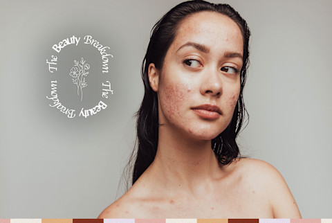 beauty breakdown adult with acne beauty breakdown adult with acne