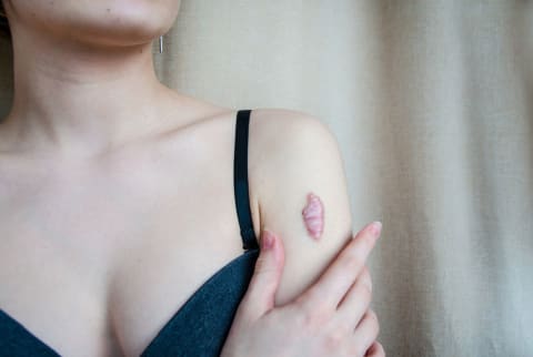 Woman with keloid scar