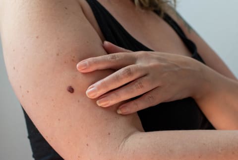 Woman with textured skin touching her arm