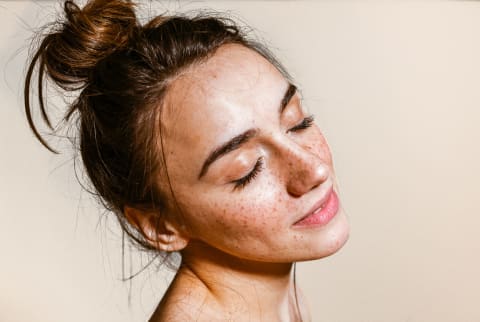 Do you have Freckles, Melasma, or Dark spots? Tips to Identifying Each