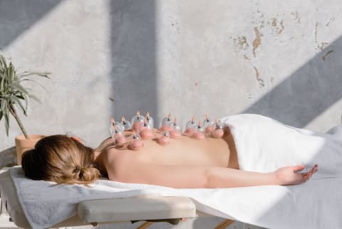 White woman lying on an acupuncture table with cupping therapy on her back