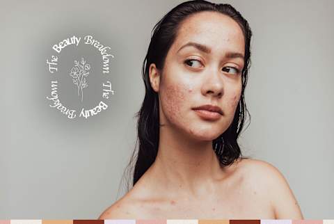 beauty breakdown adult with acne beauty breakdown adult with acne