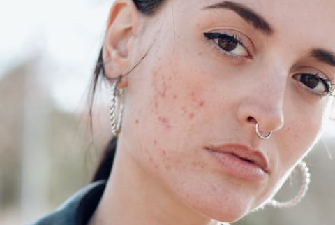 Young Woman with Acne