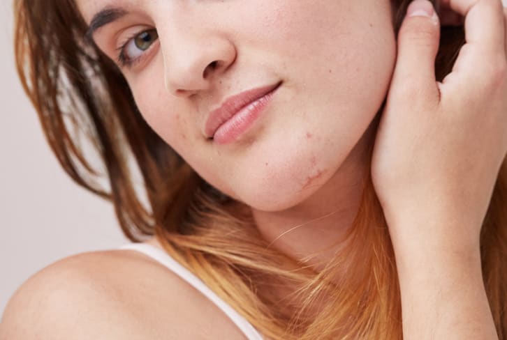 There Are Actually 7 Types Of Acne — Here's How To Treat Each Spot