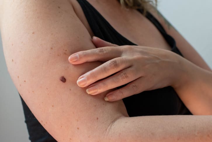 Have Bumps On Your Arms? This Surprising Habit Makes KP Worse