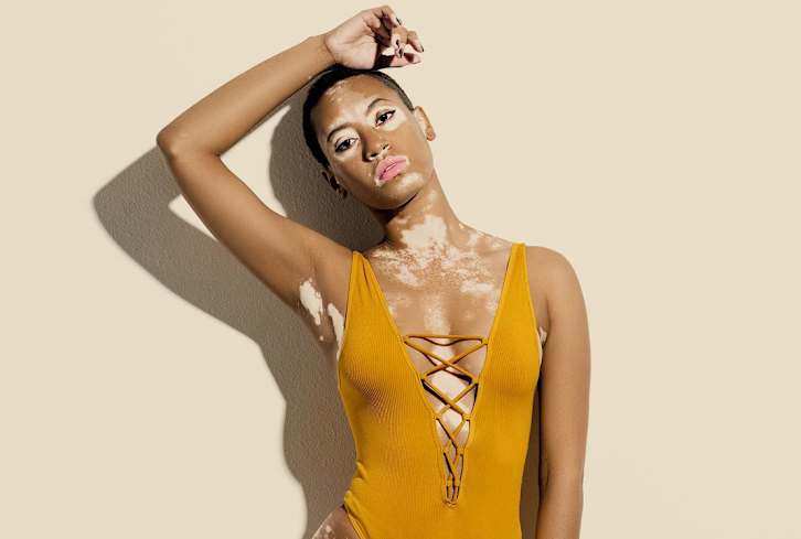 Vitiligo: Causes, Treatment & Celebration Of The Rare Skin Condition