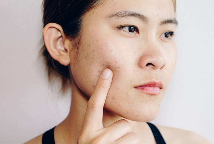 The Surprising Way To Conceal Acne Scars Without Looking Cakey