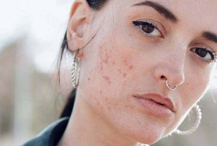 Acne Face Map: What Your Skin Breakouts Are Telling You