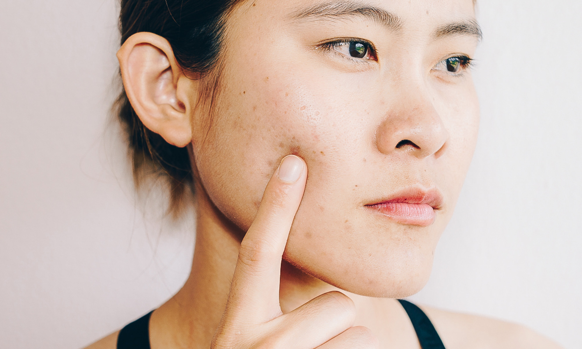 New Study Says This Method Is Way Better Than Chemical Peels For Acne Scars