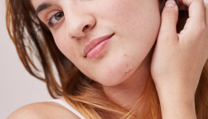 There Are Actually 7 Types Of Acne—Here's How To Treat Each Spot