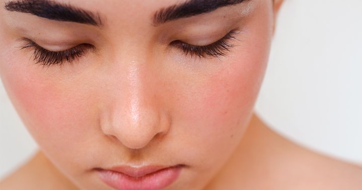 3 Surprising Rosacea Triggers You Probably Never Suspected From A Derm