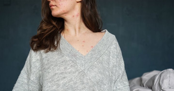 This Common Skin Condition Can Lead To Trauma, Research Says