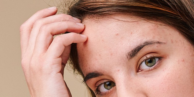 Scalp Pimples: What Causes Scalp Acne & What To Do About It | mindbodygreen