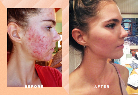 Acne before and after Acne before and after
