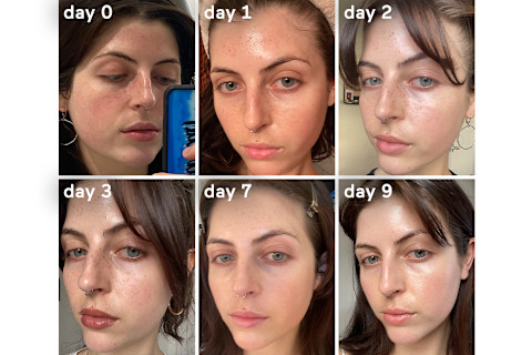 IPL before and after IPL before and after