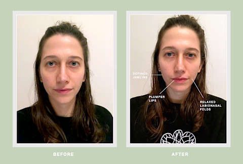 facial cupping before and after facial cupping before and after