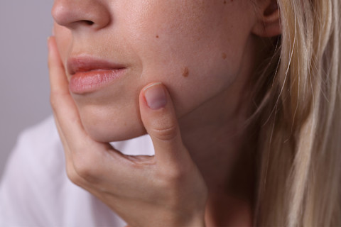 woman with moles woman with moles