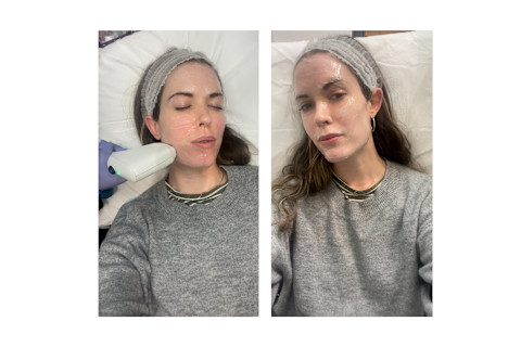mbg beauty director trying sofwave mbg beauty director trying sofwave