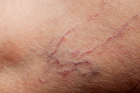 broken capillaries broken capillaries
