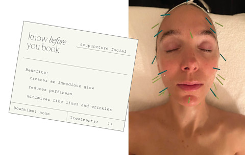 Know before you book: Acupuncture facial benefits + basic info