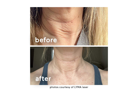 before and after of Lyma Laser usage on the neck before and after of Lyma Laser usage on the neck