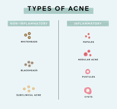 Types of acne Types of acne