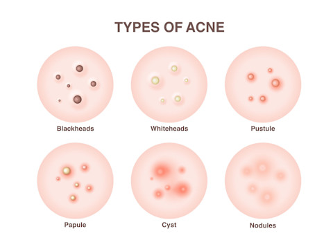types of pimples types of pimples