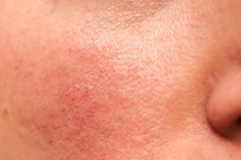 blotchy skin blotchy skin