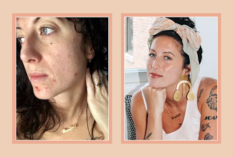 Dermatillomania with and without makeup Dermatillomania with and without makeup