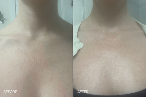 Bon Charge Red Light Neck & Chest Mask Review: Before & After Bon Charge Red Light Neck & Chest Mask Review: Before & After