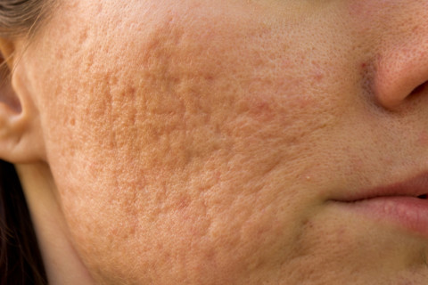 woman with acne scars woman with acne scars