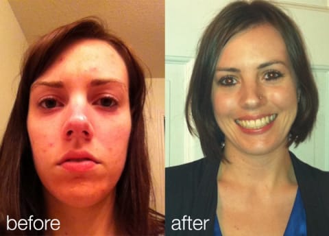 How Eliminating Gluten   Dairy Helped Clear Up My Acne - 38