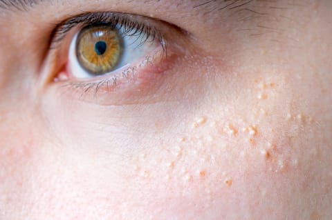 Close Up of a Person With Milia Around Eye