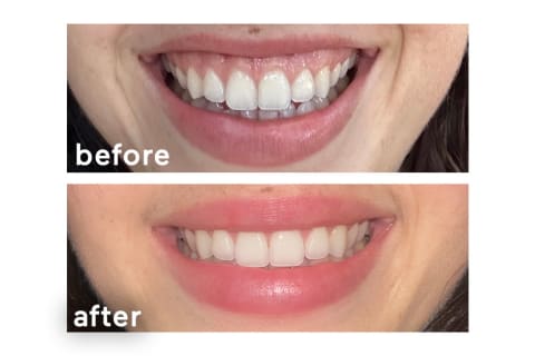 before and after teeth whitening