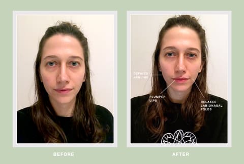 facial cupping before and after