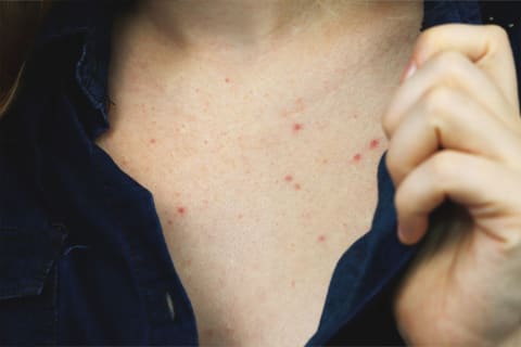 6 Ways To Get Rid Of Chest Acne   What Causes It  From Derms - 85