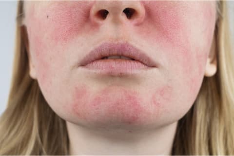 woman with rosacea
